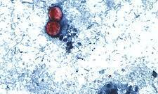 CDC: 15 States Now Linked to Cyclospora Outbreak